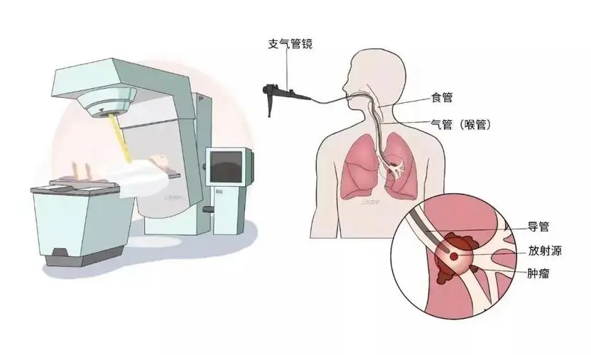 支气管镜检查注意事项